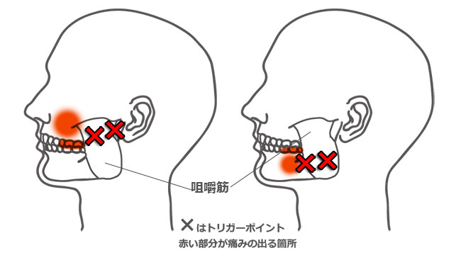 肩こり