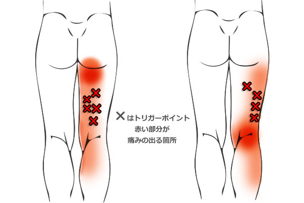 痛い 股関節 太ももの付け根が痛いときは股関節の異常？考えられる病態とは