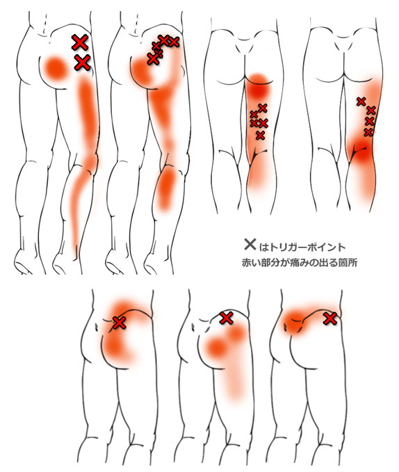 マッサージ 坐骨 神経痛 坐骨神経痛に効くマッサージとツボ【自分で何とかしたい人向け】