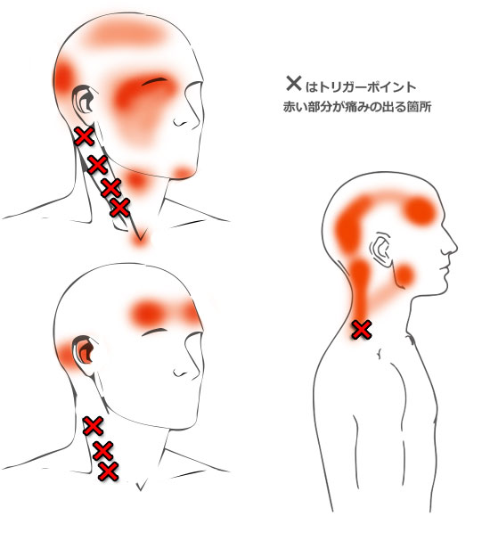 場所 頭痛