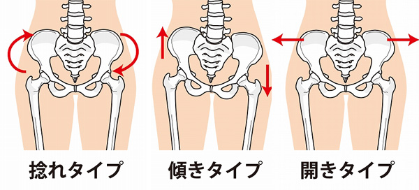 骨盤の歪みの図