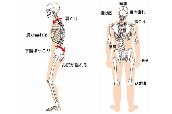 体の歪み